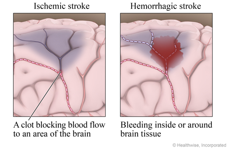 Ischemic and hemorrhagic stroke