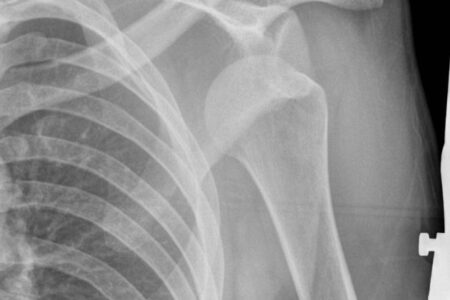 Shoulder Dislocation X- Ray- Informative for Shoulder Dislocation Physiotherapy