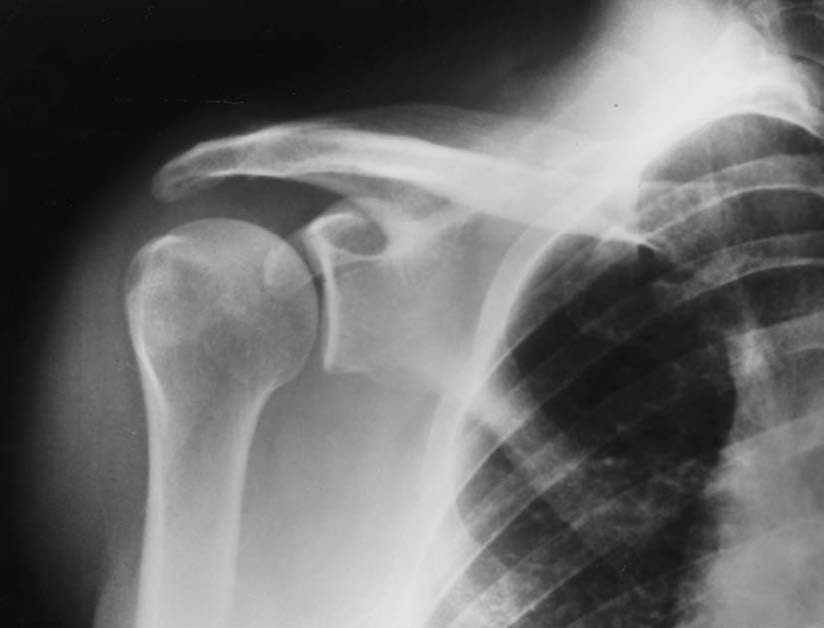 Shoulder X- Ray- Informative for Shoulder Dislocation Physiotherapy