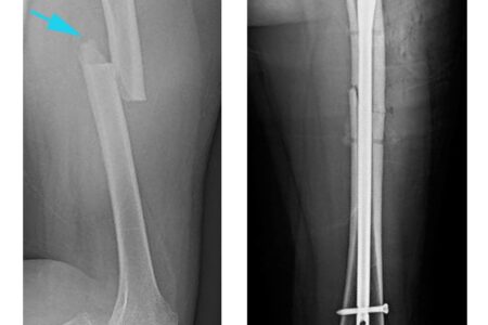 Femur Femoral Shaft Fracture Physiotherapy