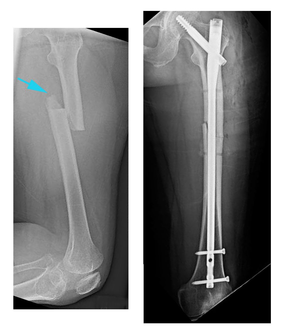 Femur Femoral Shaft Fracture Physiotherapy